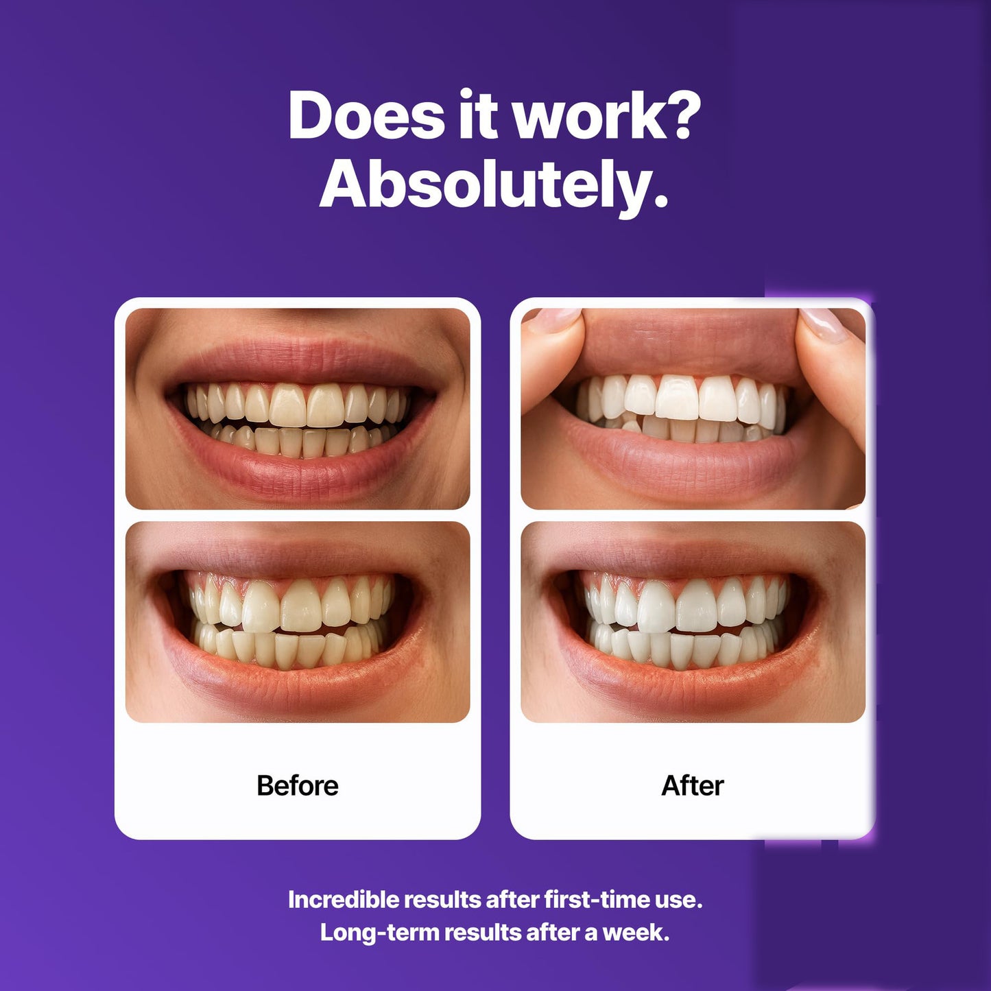 Dental Whitening Strips Enamel Safe